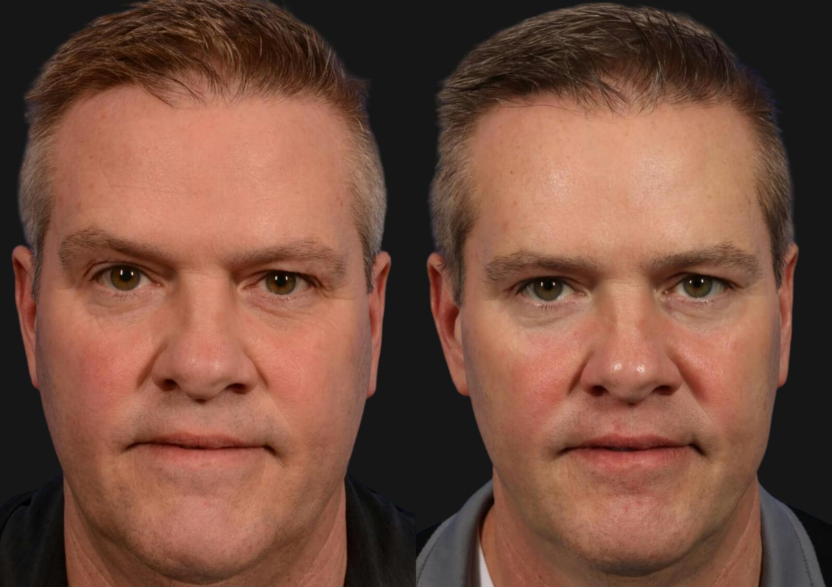 Brow Lift Before & After Gallery - Patient 198008 - Image 1