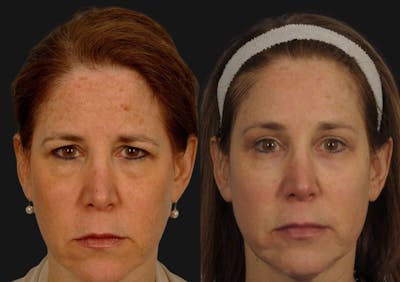Brow Lift Before & After Gallery - Patient 413242 - Image 1