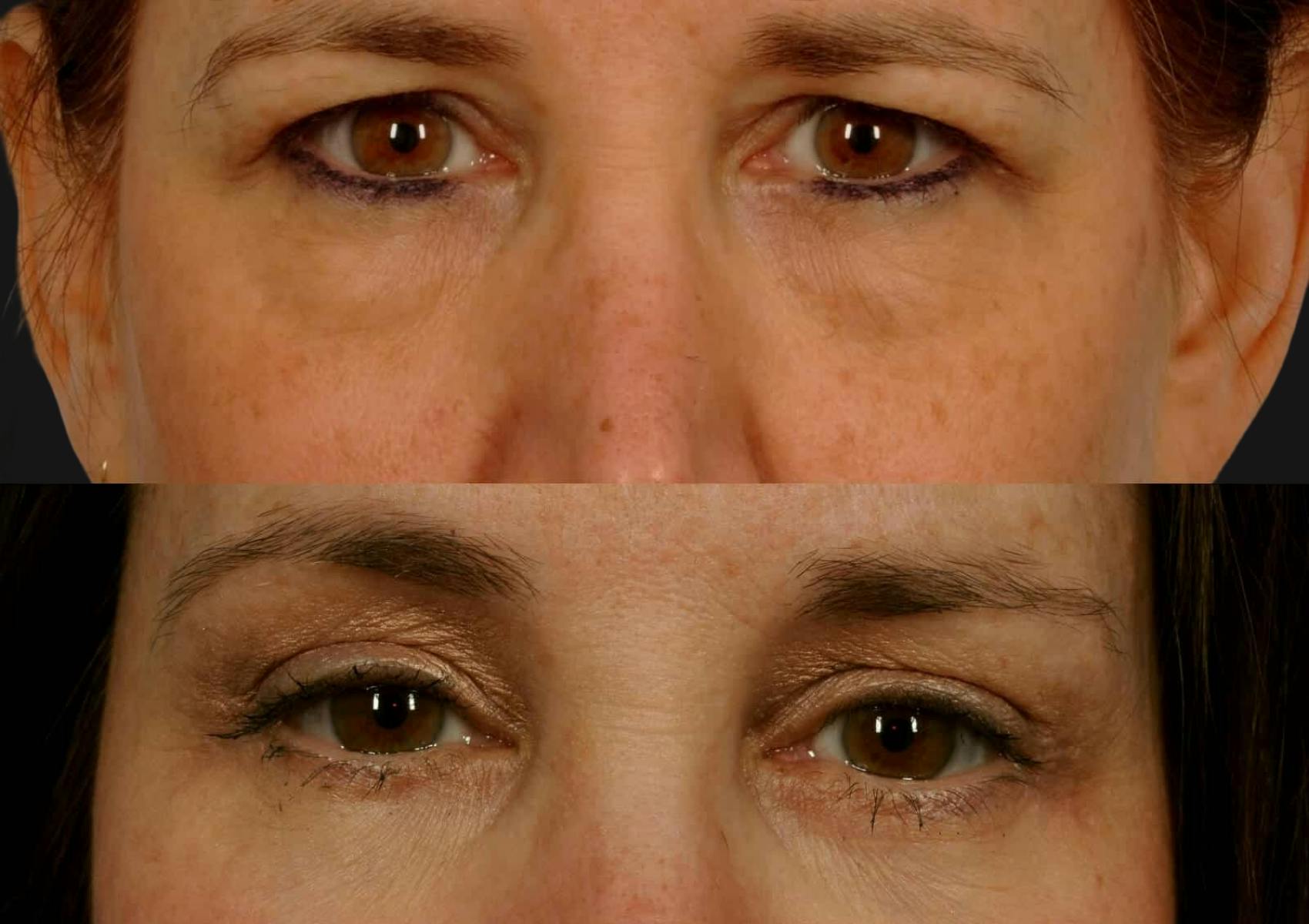 Brow Lift Before & After Gallery - Patient 413242 - Image 2