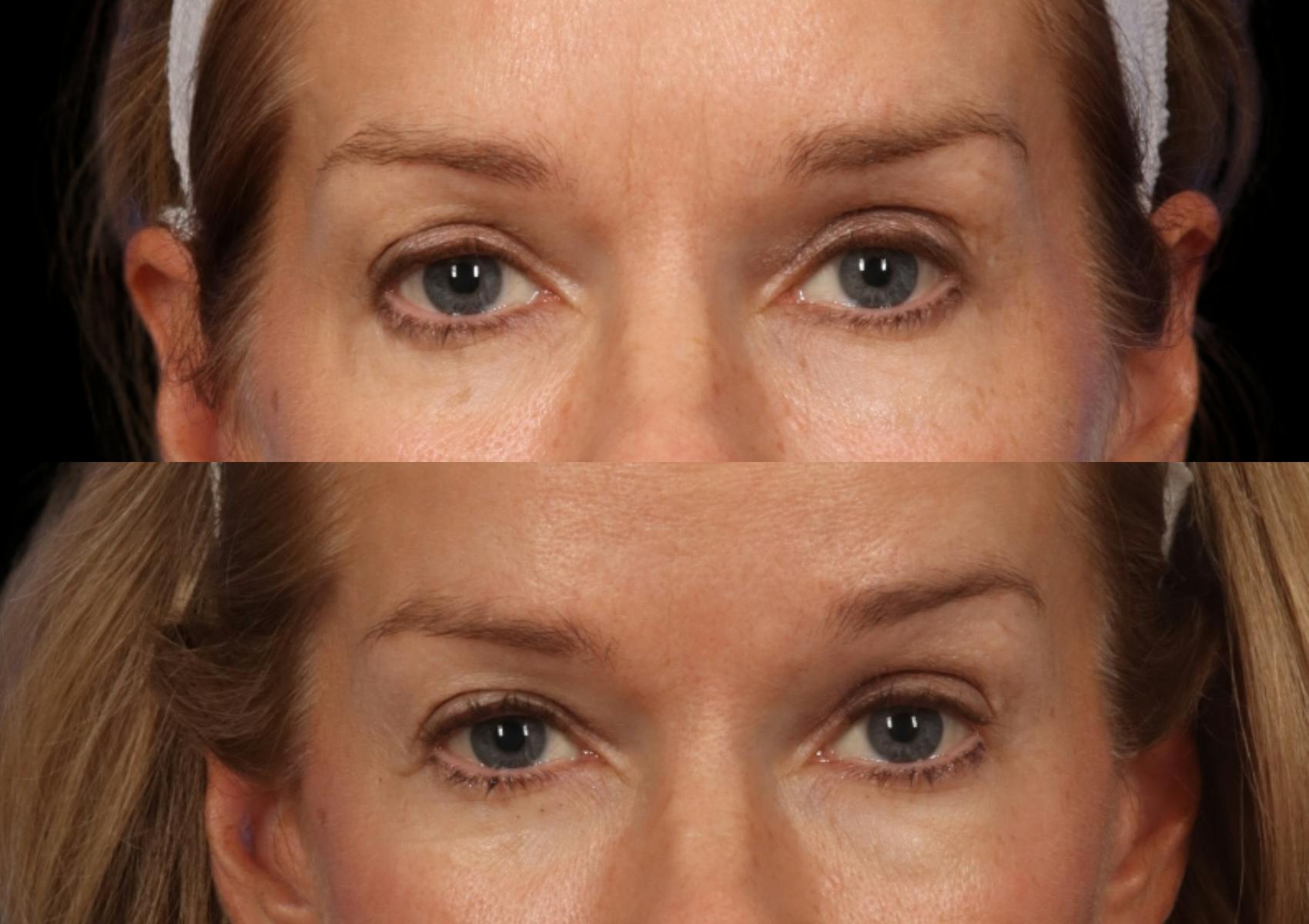 Brow Lift Before & After Gallery - Patient 467102 - Image 2