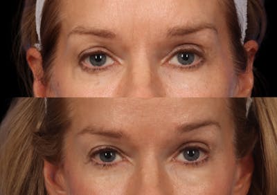 Brow Lift Before & After Gallery - Patient 467102 - Image 2