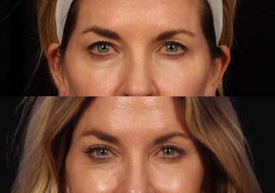 Brow Lift Before & After Gallery - Patient 587999 - Image 2