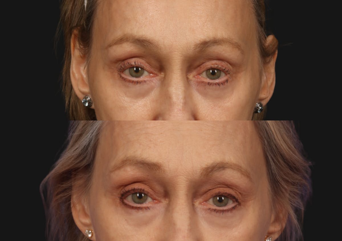 Brow Lift Before & After Gallery - Patient 730628 - Image 2