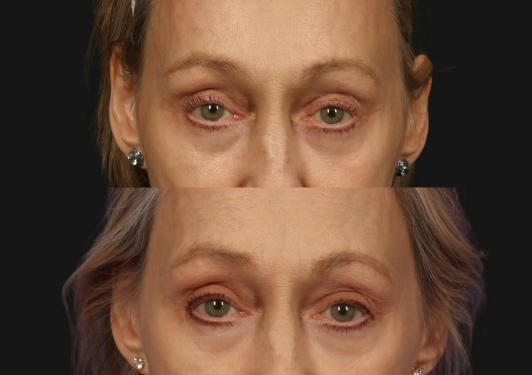 Brow Lift Before & After Gallery - Patient 730628 - Image 2