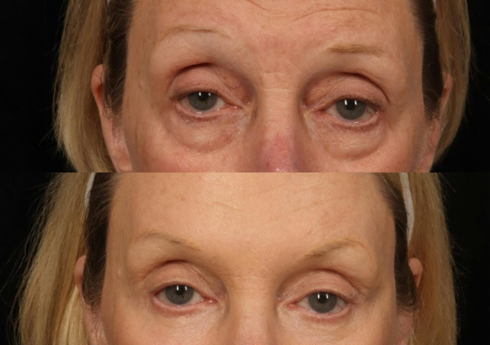 Brow Lift Before & After Gallery - Patient 387586 - Image 2