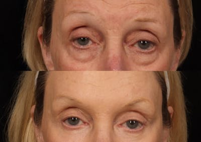 Brow Lift Before & After Gallery - Patient 387586 - Image 2