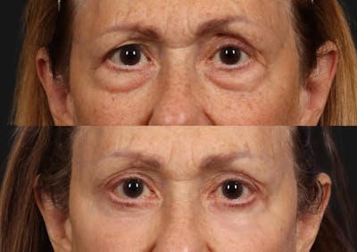 Brow Lift Before & After Gallery - Patient 242960 - Image 1