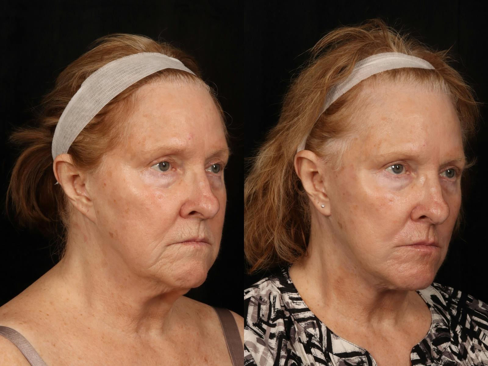 Facelift Before & After Gallery - Patient 255443 - Image 1
