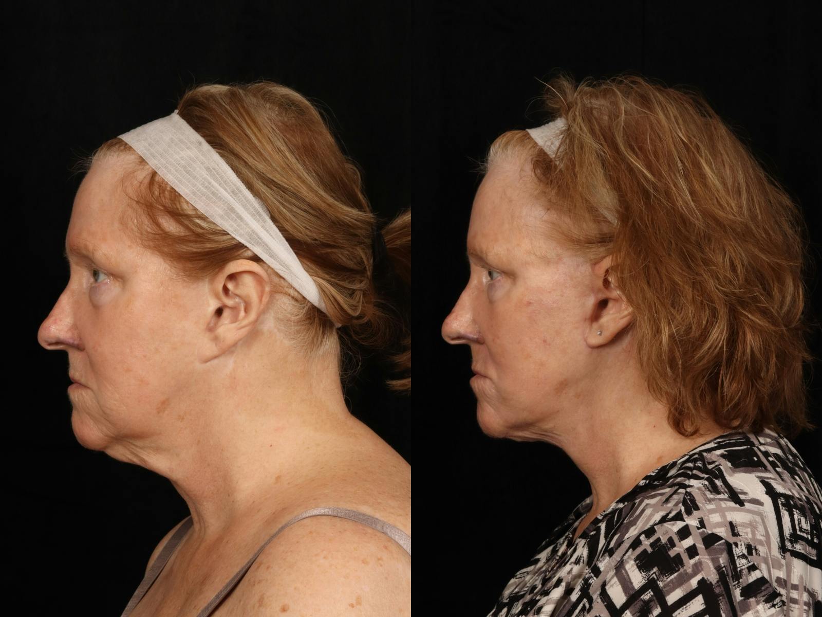 Facelift Before & After Gallery - Patient 255443 - Image 2