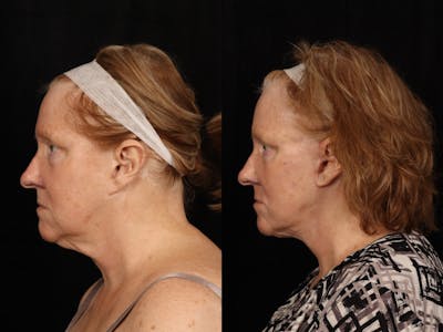 Facelift Before & After Gallery - Patient 255443 - Image 2