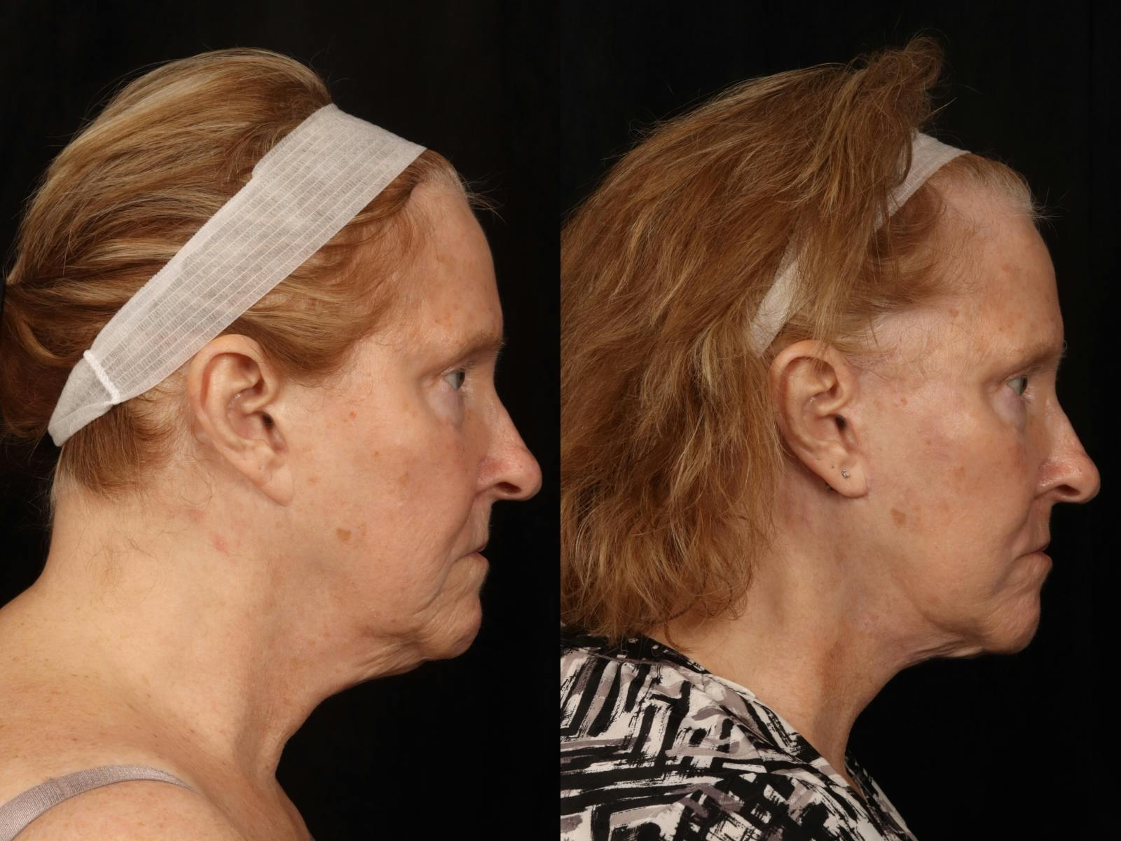 Facelift Before & After Gallery - Patient 255443 - Image 3