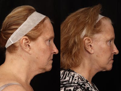 Facelift Before & After Gallery - Patient 255443 - Image 3