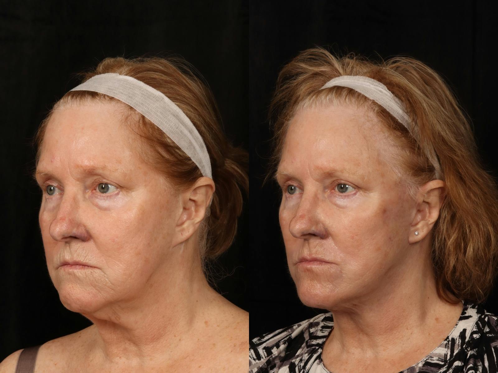 Facelift Before & After Gallery - Patient 255443 - Image 4