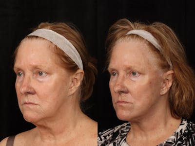 Facelift Before & After Gallery - Patient 255443 - Image 4