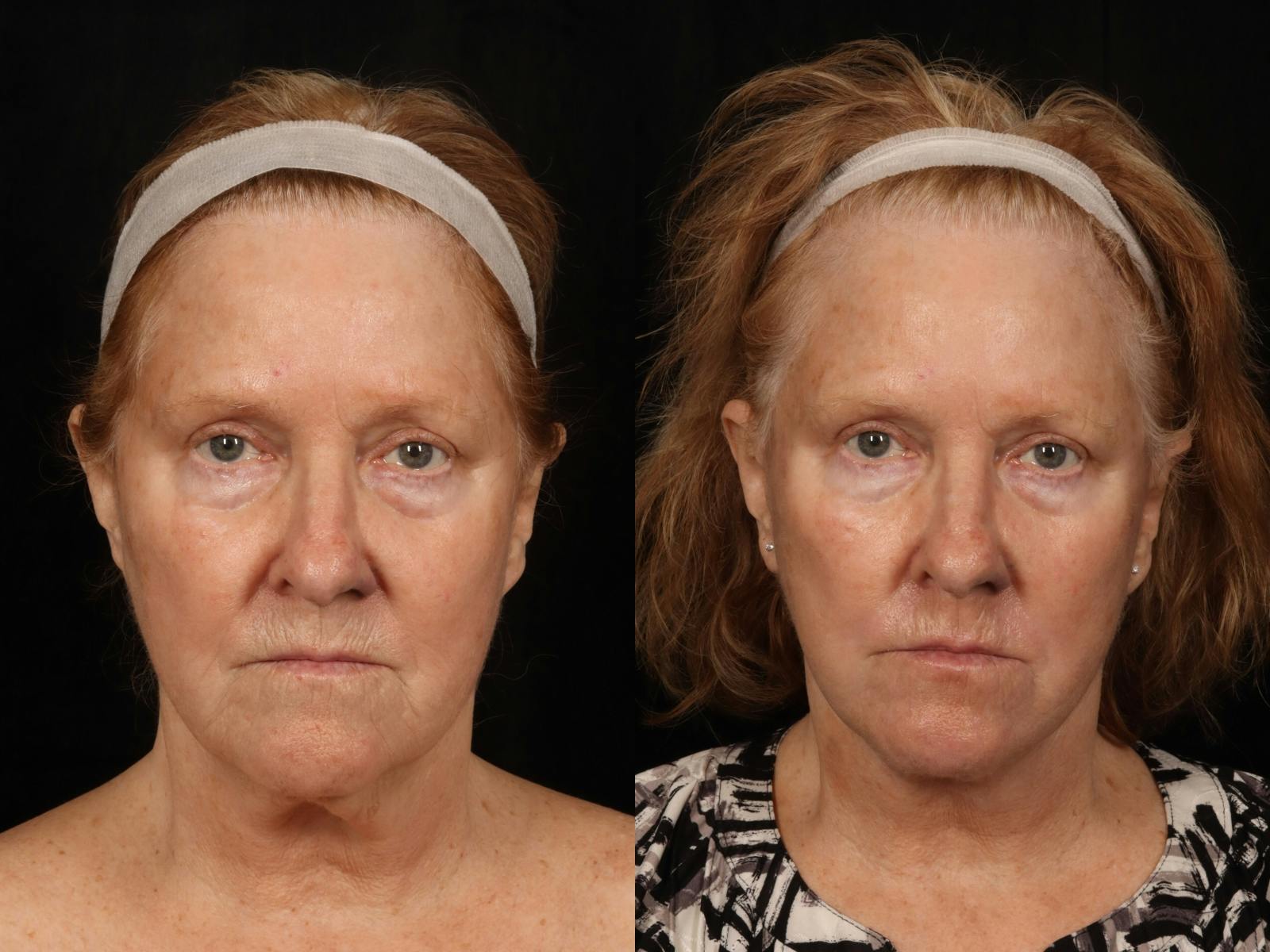 Facelift Before & After Gallery - Patient 255443 - Image 5