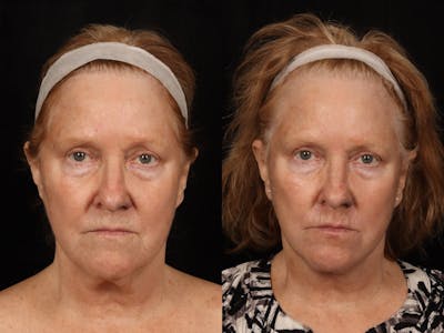 Facelift Before & After Gallery - Patient 255443 - Image 5