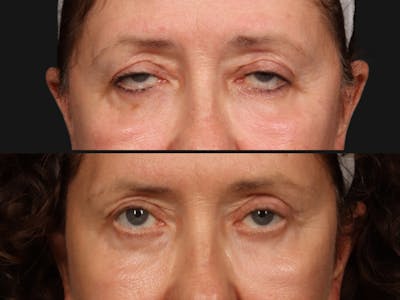 Eyelid Revision Surgery Before & After Gallery - Patient 668043 - Image 2