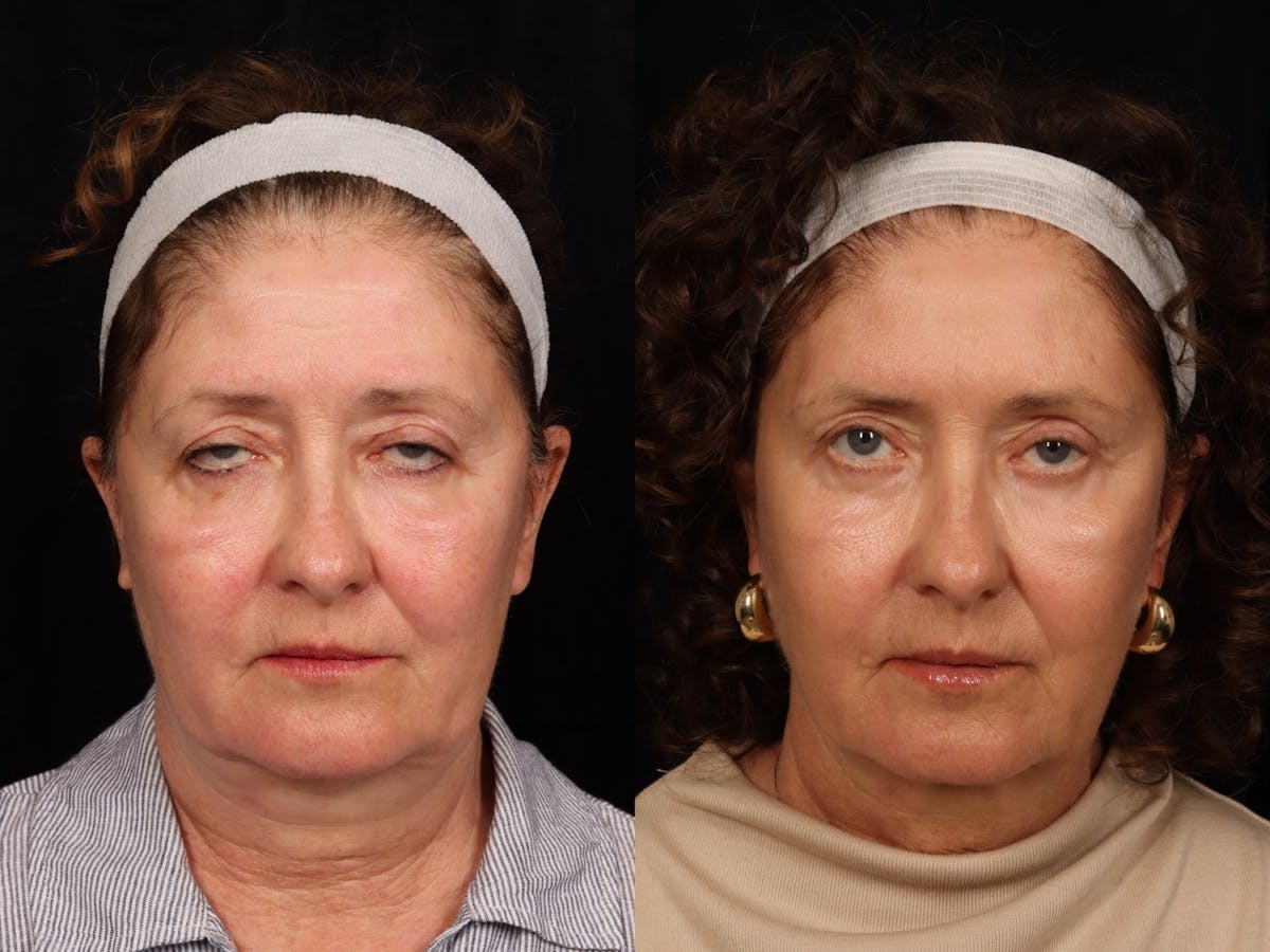 Eyelid Revision Surgery Before & After Gallery - Patient 668043 - Image 1