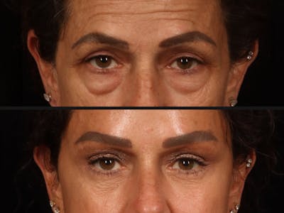 Blepharoplasty Before & After Gallery - Patient 823782 - Image 2