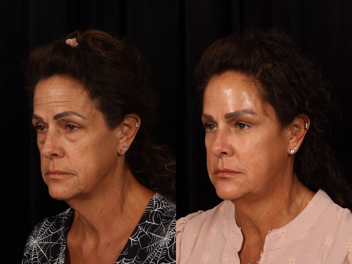 Liposculpture Before & After Gallery - Patient 186471 - Image 3