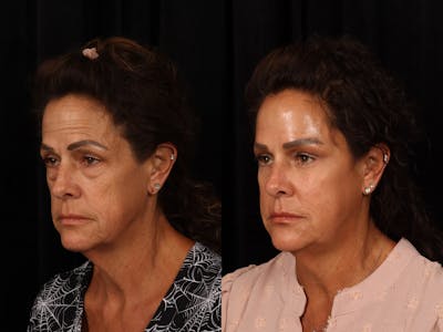 Mid Facelift Before & After Gallery - Patient 130175 - Image 2