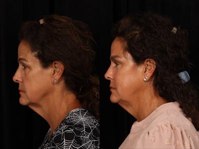 Mid Facelift Before & After Gallery - Patient 130175 - Image 4