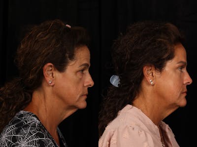 Mid Facelift Before & After Gallery - Patient 130175 - Image 3
