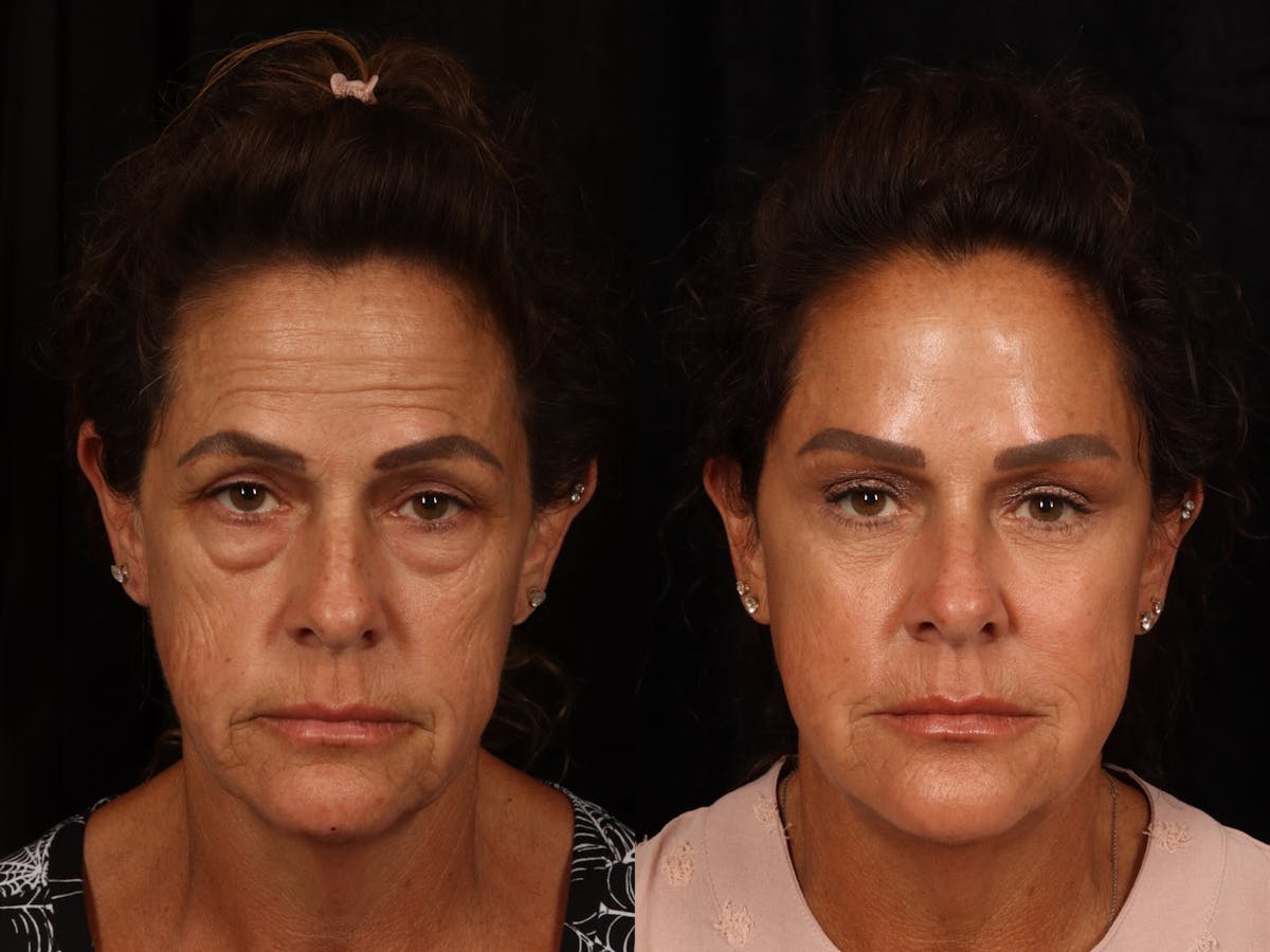Liposculpture Before & After Gallery - Patient 186471 - Image 1