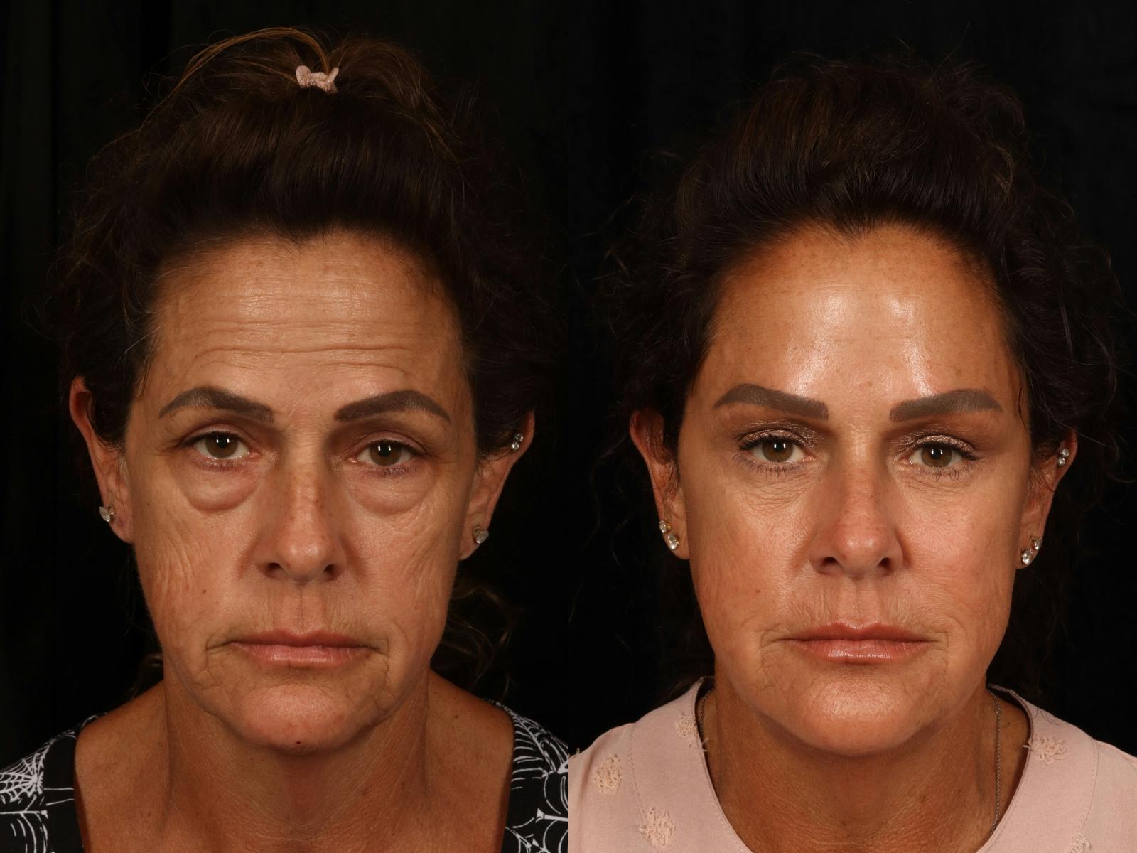 Liposculpture Before & After Gallery - Patient 186471 - Image 1