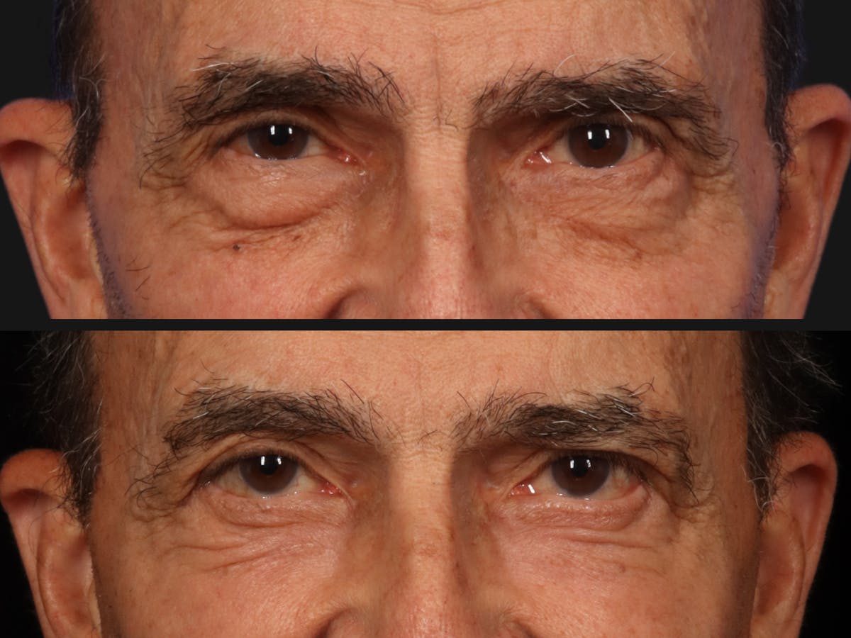 Blepharoplasty Before & After Gallery - Patient 233899 - Image 1