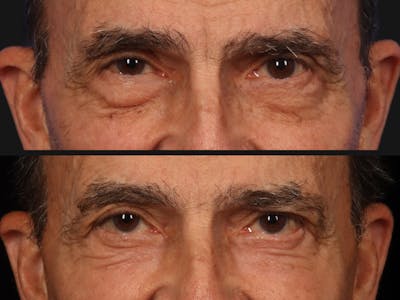 Blepharoplasty Before & After Gallery - Patient 233899 - Image 1
