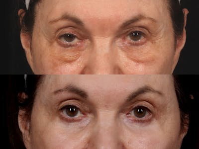 Blepharoplasty Before & After Gallery - Patient 229083 - Image 1