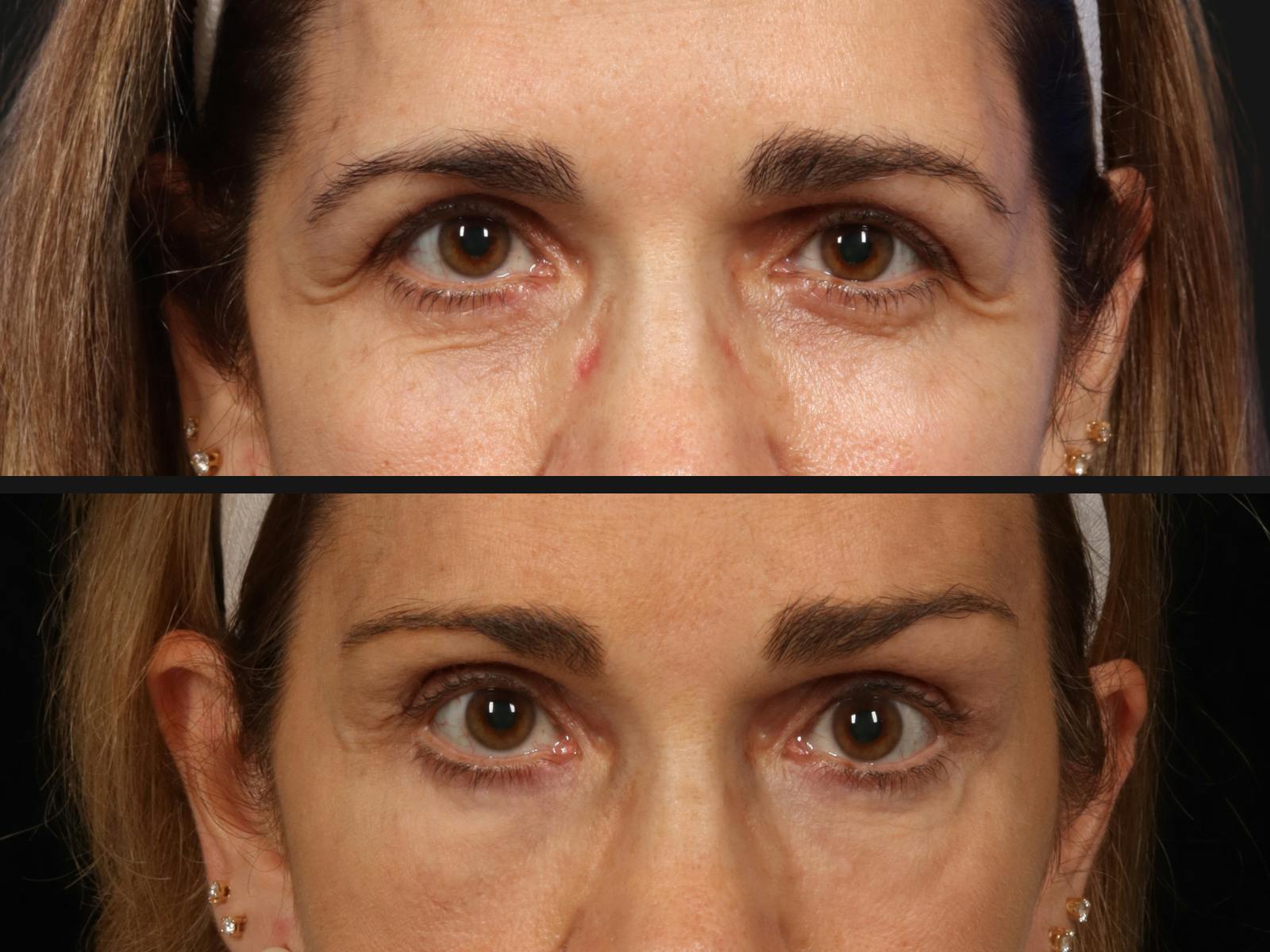 Blepharoplasty Before & After Gallery - Patient 272462 - Image 2