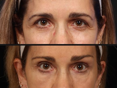 Blepharoplasty Before & After Gallery - Patient 272462 - Image 2