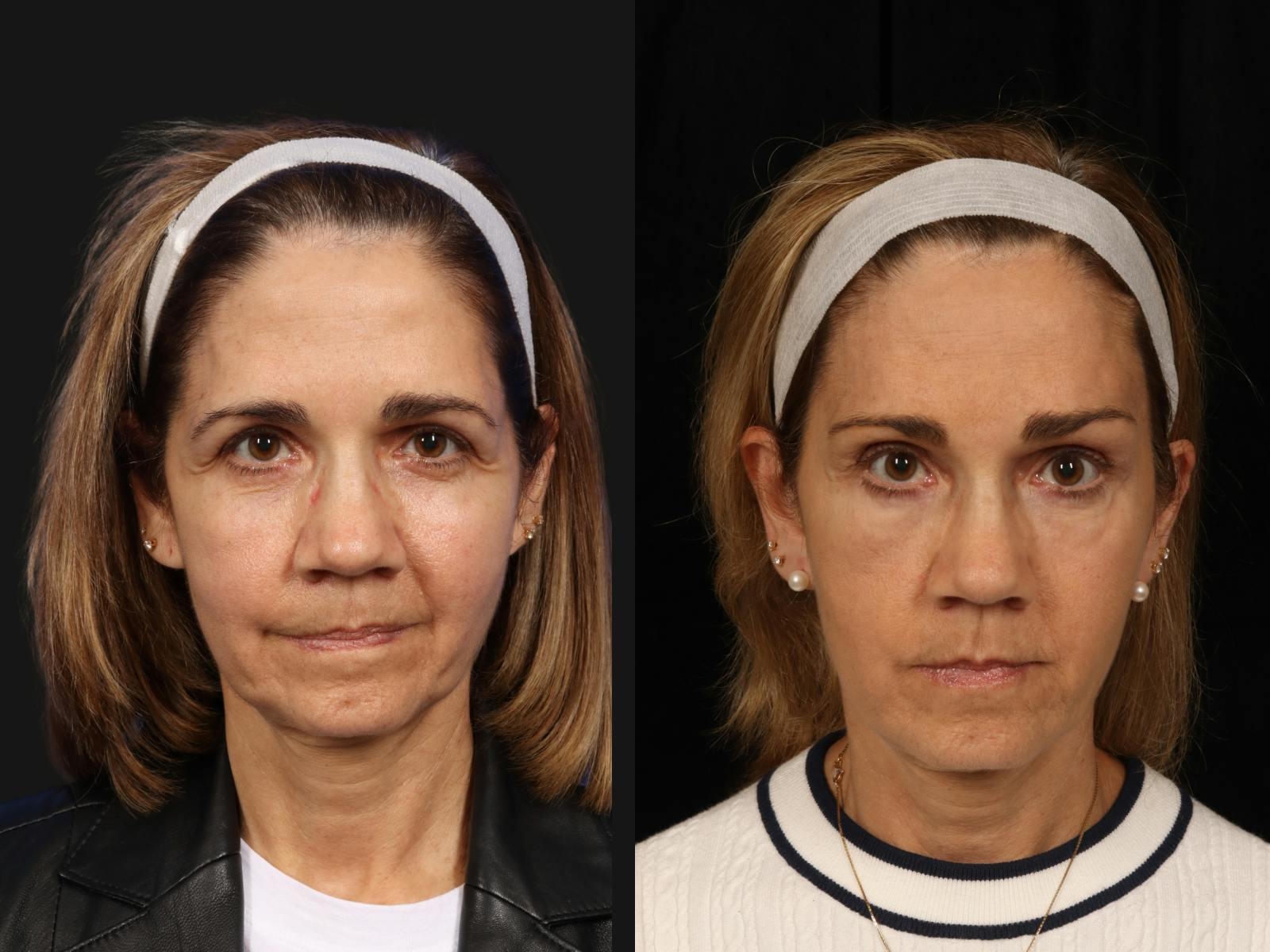 Blepharoplasty Before & After Gallery - Patient 272462 - Image 1