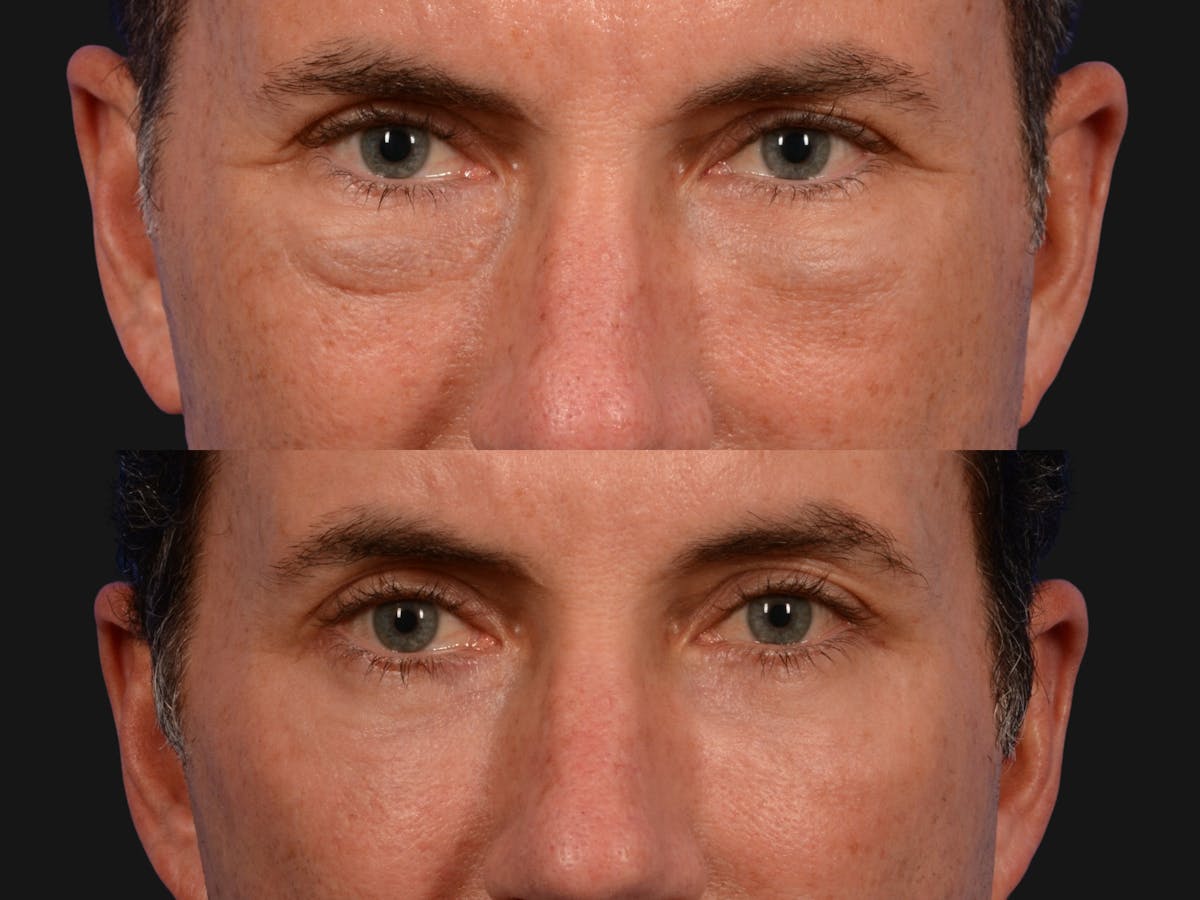 Laser Skin Resurfacing Before & After Gallery - Patient 249263 - Image 2