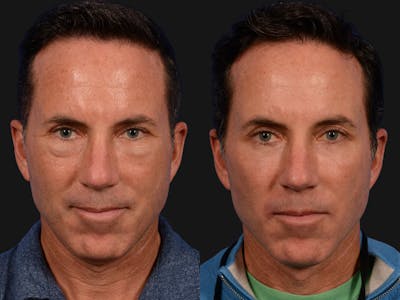 Blepharoplasty Before & After Gallery - Patient 997628 - Image 1