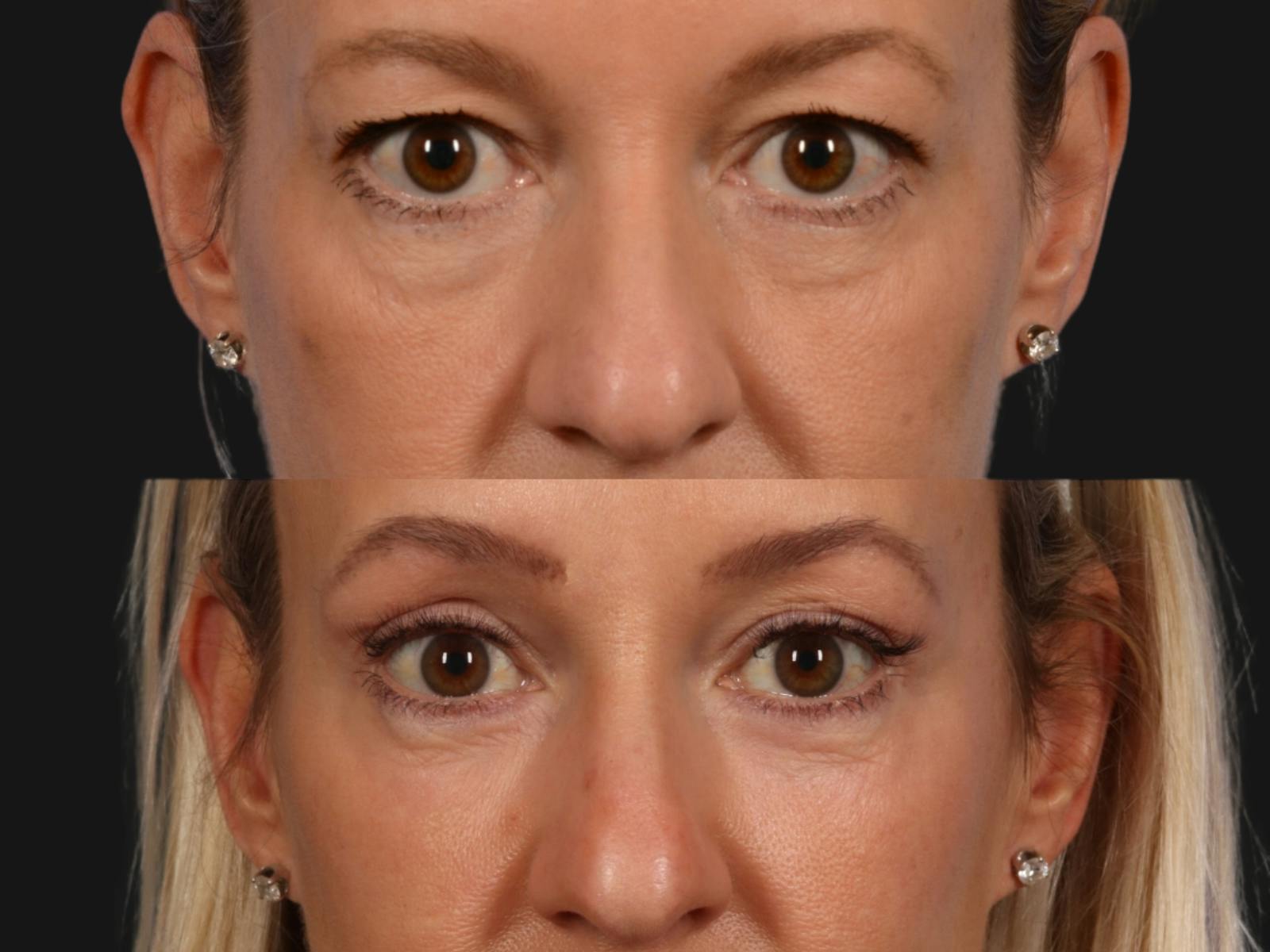 Blepharoplasty Before & After Gallery - Patient 349090 - Image 2