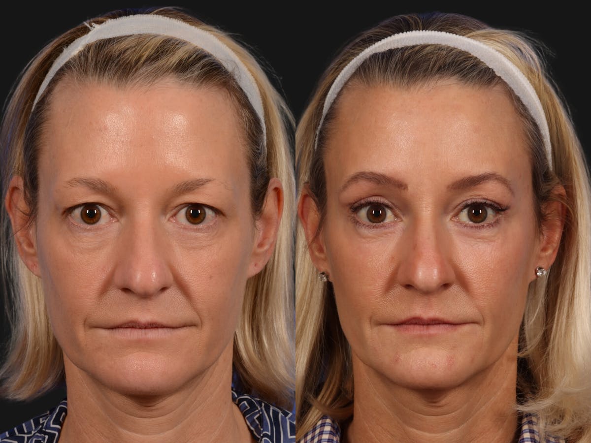 Mid Facelift Before & After Gallery - Patient 332380 - Image 1