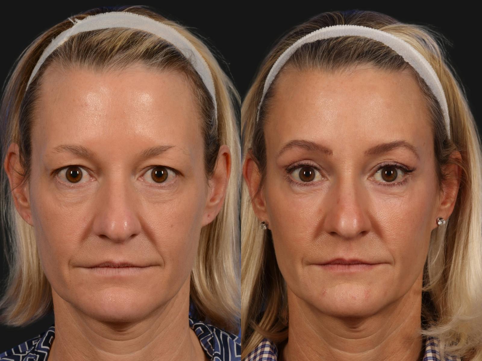Blepharoplasty Before & After Gallery - Patient 349090 - Image 1