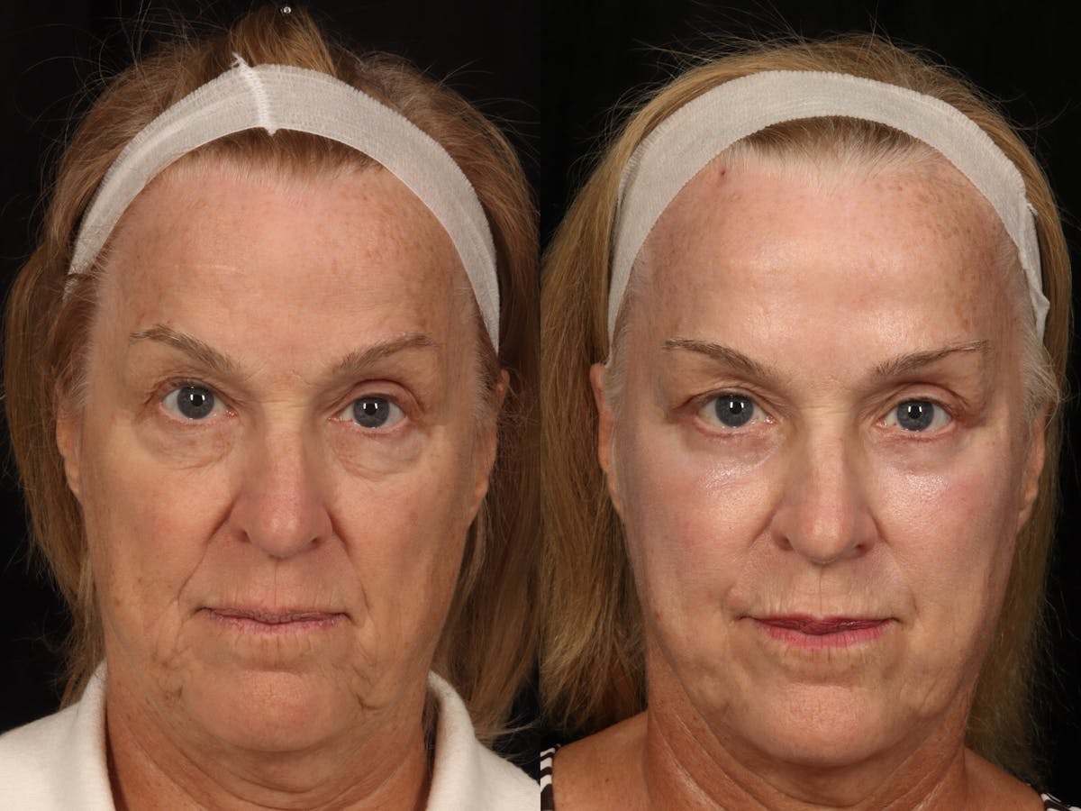 Blepharoplasty Before & After Gallery - Patient 305598 - Image 1