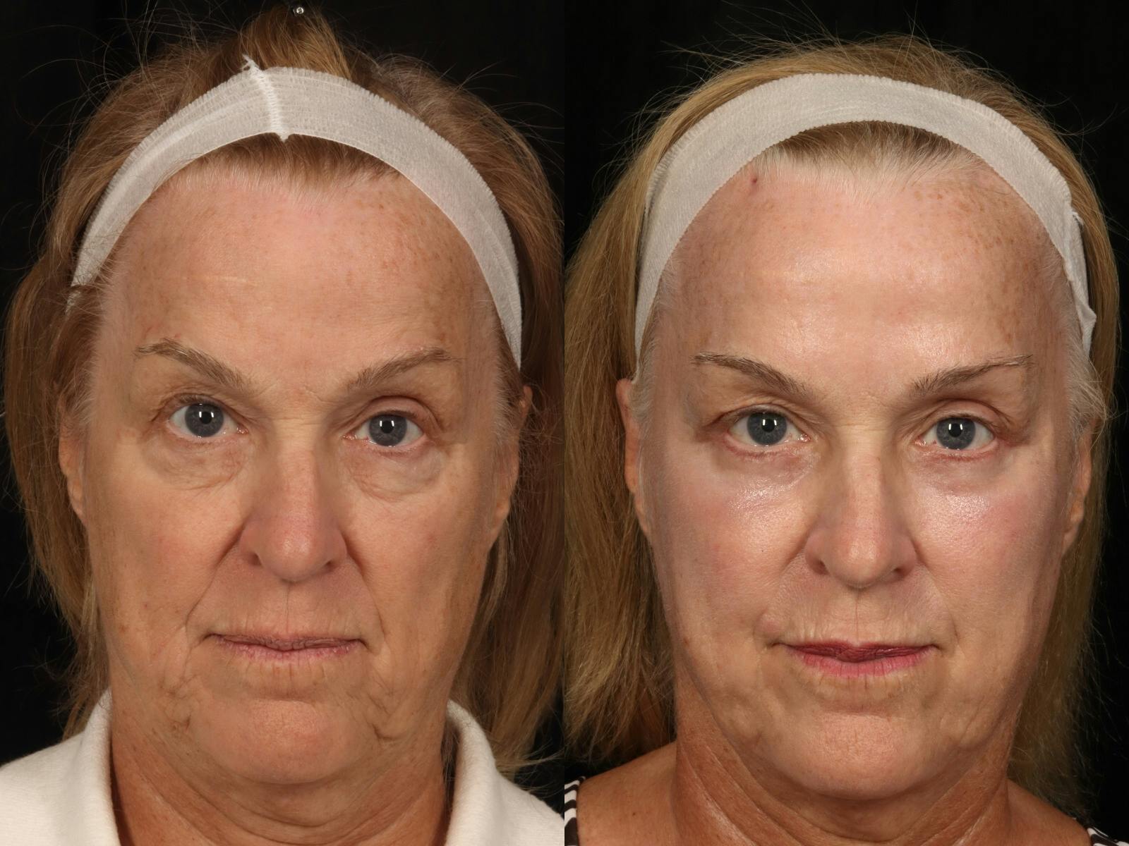 Blepharoplasty Before & After Gallery - Patient 862437 - Image 1