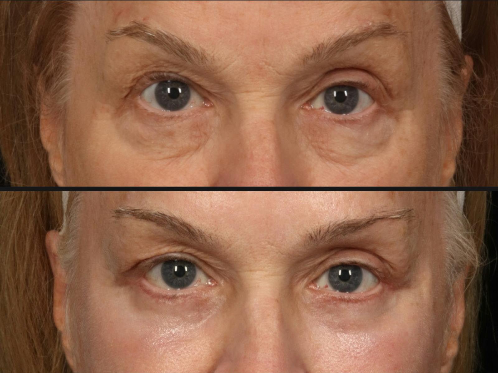 Blepharoplasty Before & After Gallery - Patient 862437 - Image 2