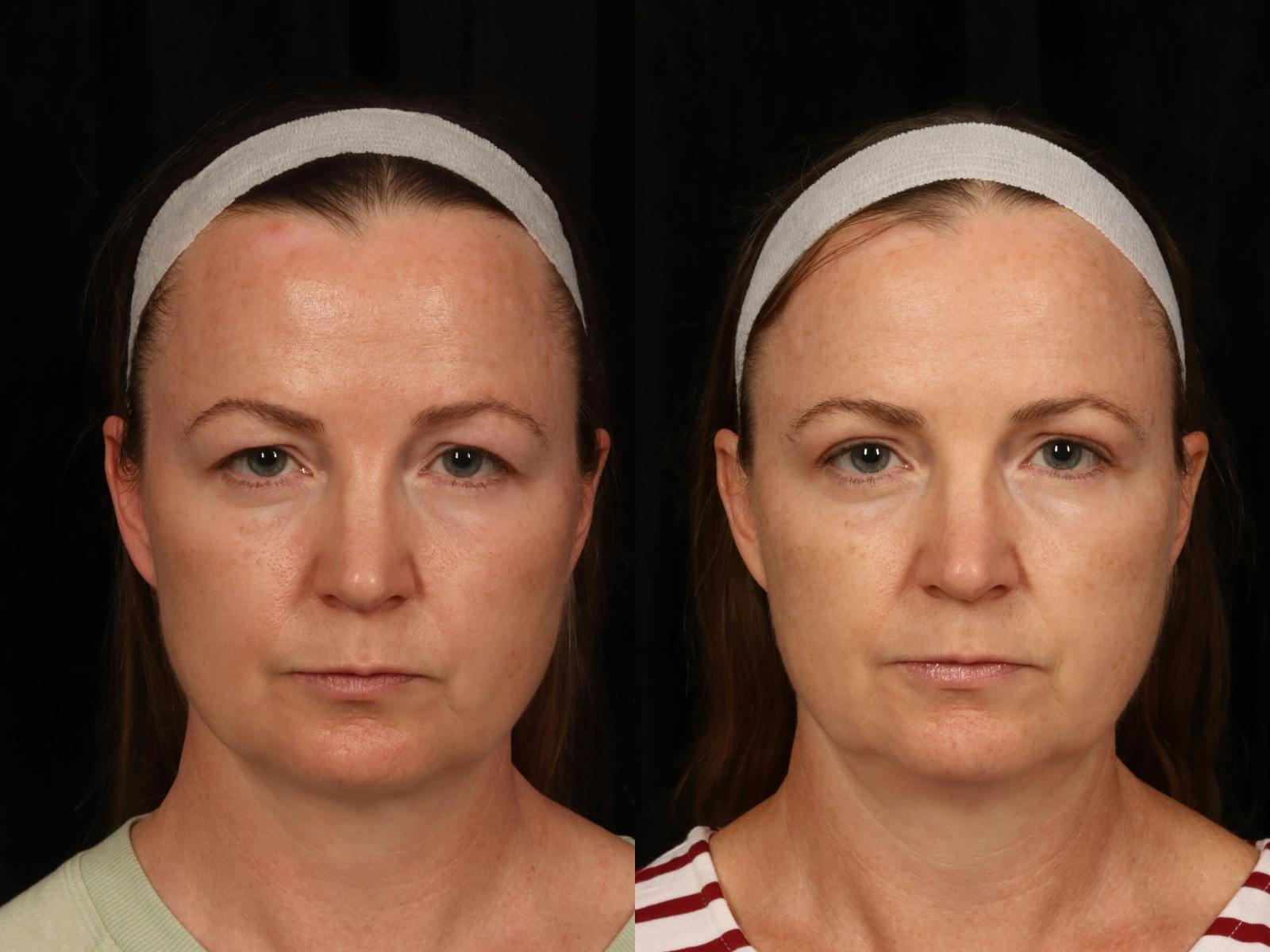 Blepharoplasty Before & After Gallery - Patient 285634 - Image 1