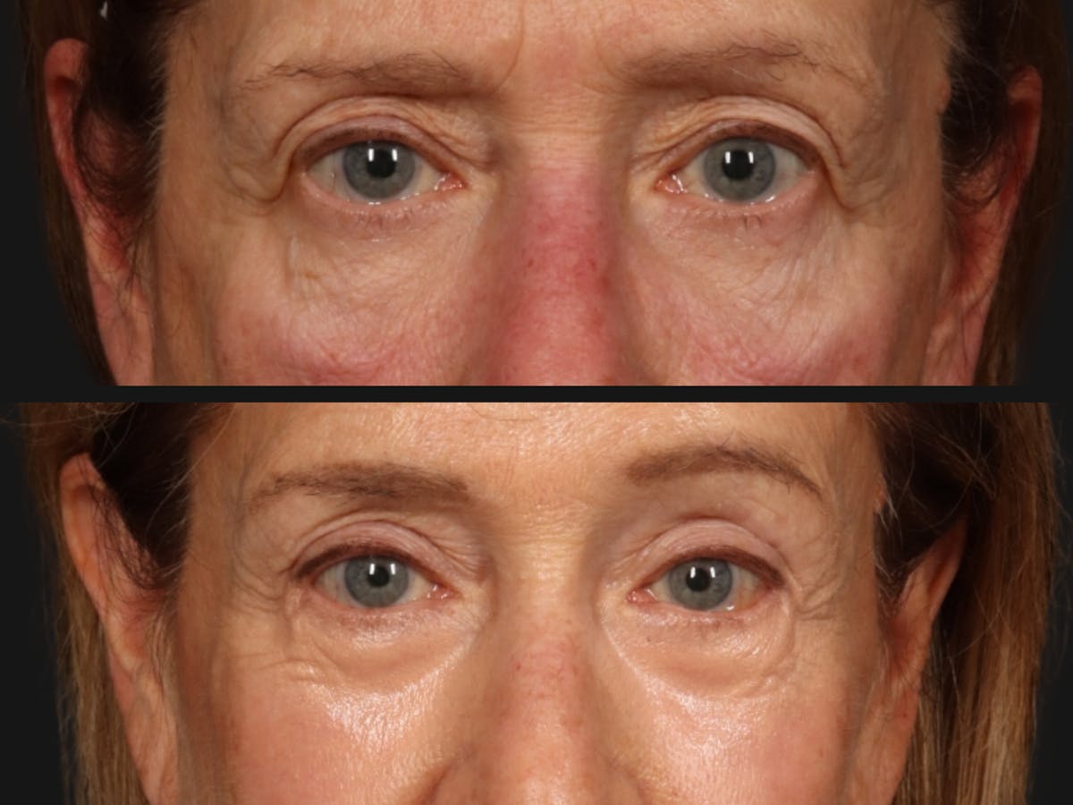 Festoon Surgery Before & After Gallery - Patient 162573 - Image 2