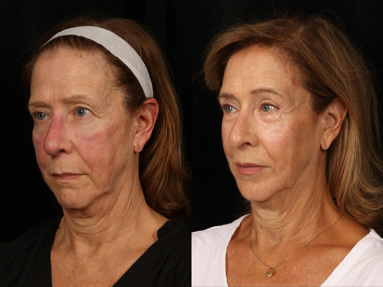 Mid Facelift Before & After Gallery - Patient 191073 - Image 3