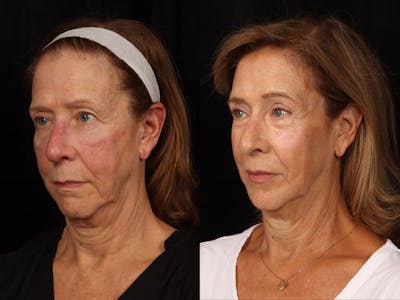 Mid Facelift Before & After Gallery - Patient 191073 - Image 3