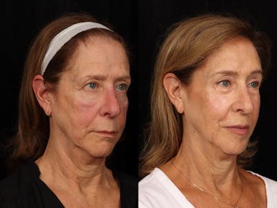 Mid Facelift Before & After Gallery - Patient 191073 - Image 5