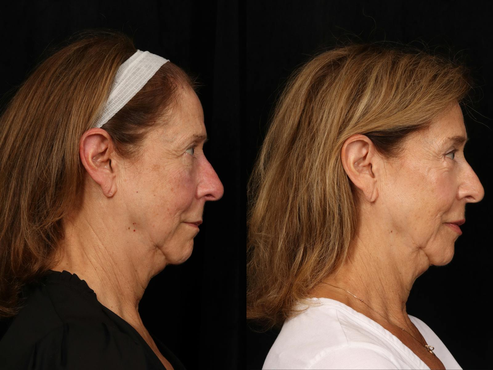 Mid Facelift Before & After Gallery - Patient 191073 - Image 4