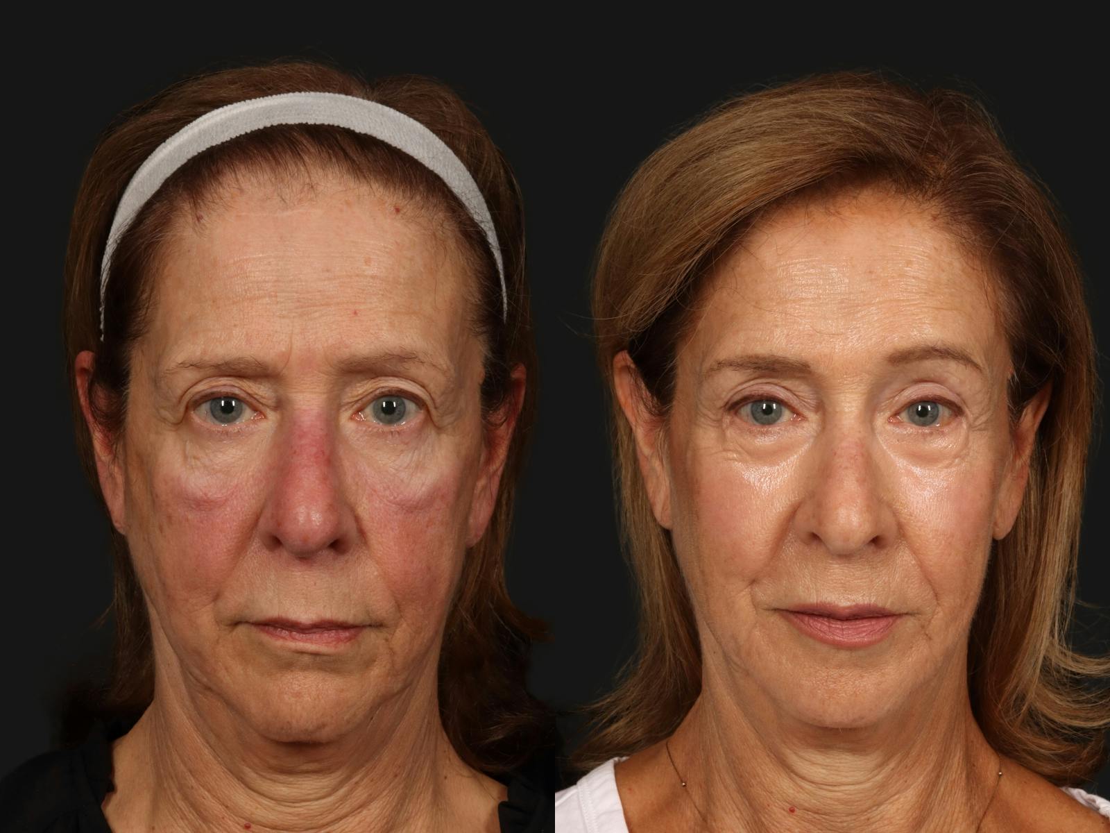 Brow Lift Before & After Gallery - Patient 388247 - Image 1